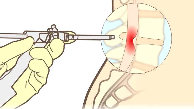 Duración de la baja por hernia discal: ¿Cuánto tiempo?
